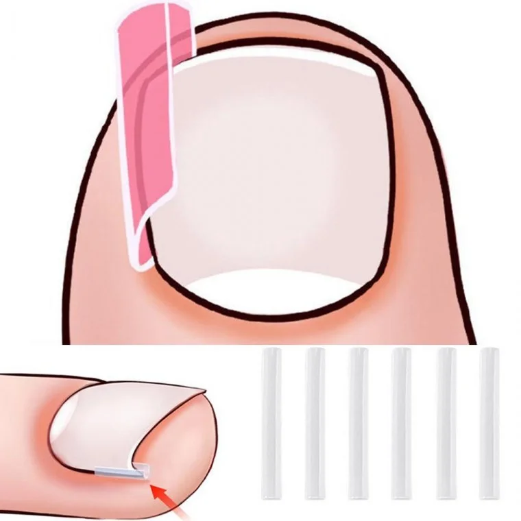 말린발톱 보호 지지대 내향성발톱 발톱와이어 스틱 발톱테이프 테이핑 내향형발톱