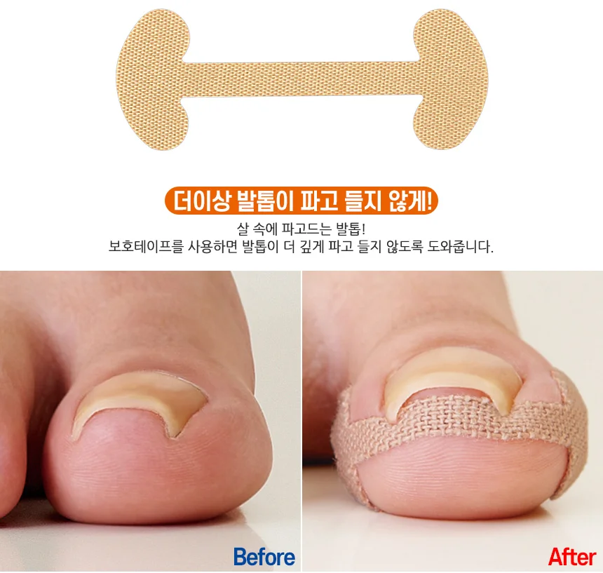 내성발톱방지테이프 보호테이프 발톱관리도구 상세2
