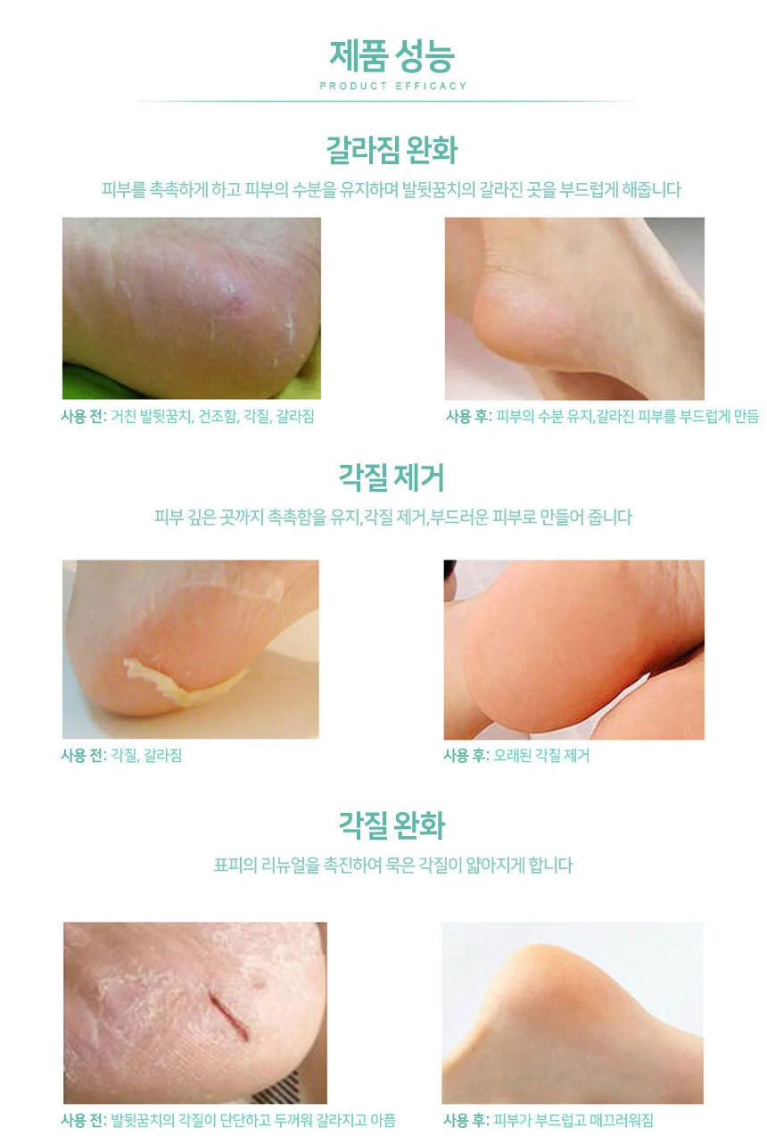 풋케어 발뒤꿈치 패드 발바닥 패치 발각질 상세3
