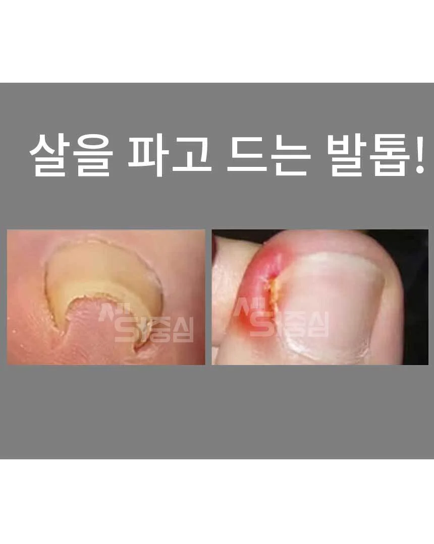 내성발톱 스티커 발톱케어 보호 밴드 발톱관리 페디밴드 40개 AG 상세2